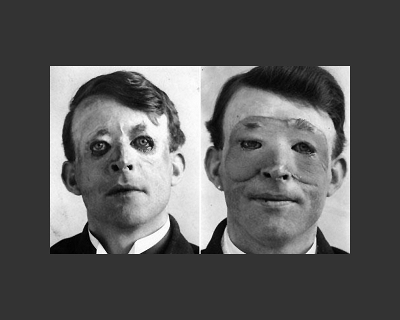 Walter Yeo, a sailor, before (left) and after (right) skin flap surgery performed by Gillies in 1917